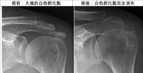 長期肩膀疼痛    慎防鈣化性肌腱炎作怪